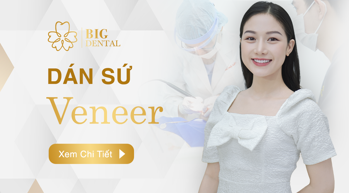 Dán sứ Veneer