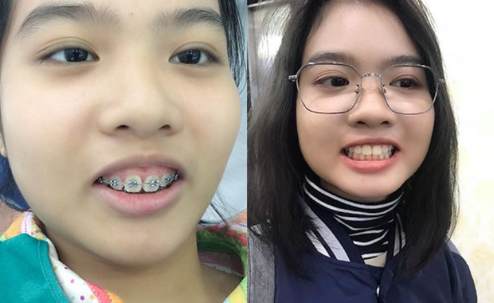 Khuôn mặt biến dạng, mất thẩm mỹ nghiêm trọng