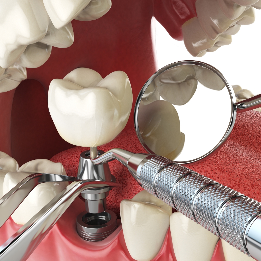 Trồng răng Implant