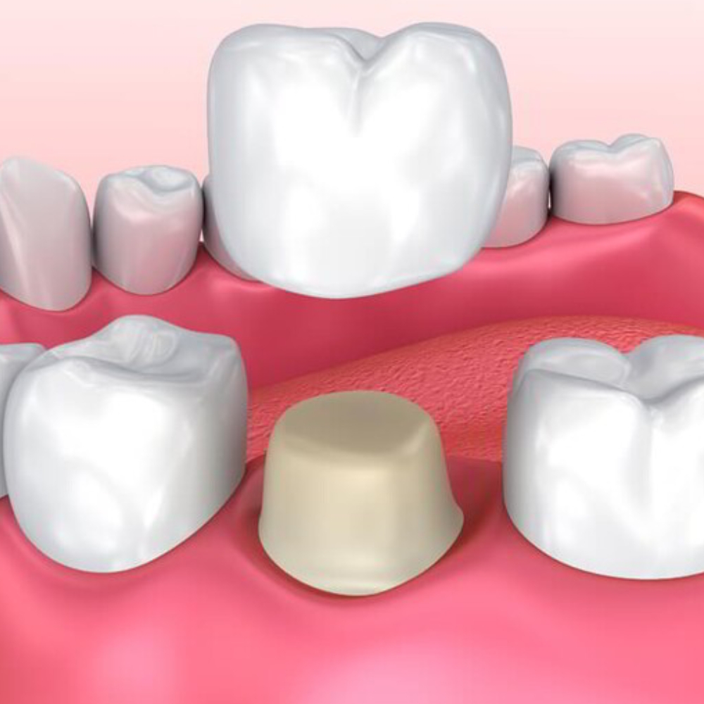 Trồng răng Implant