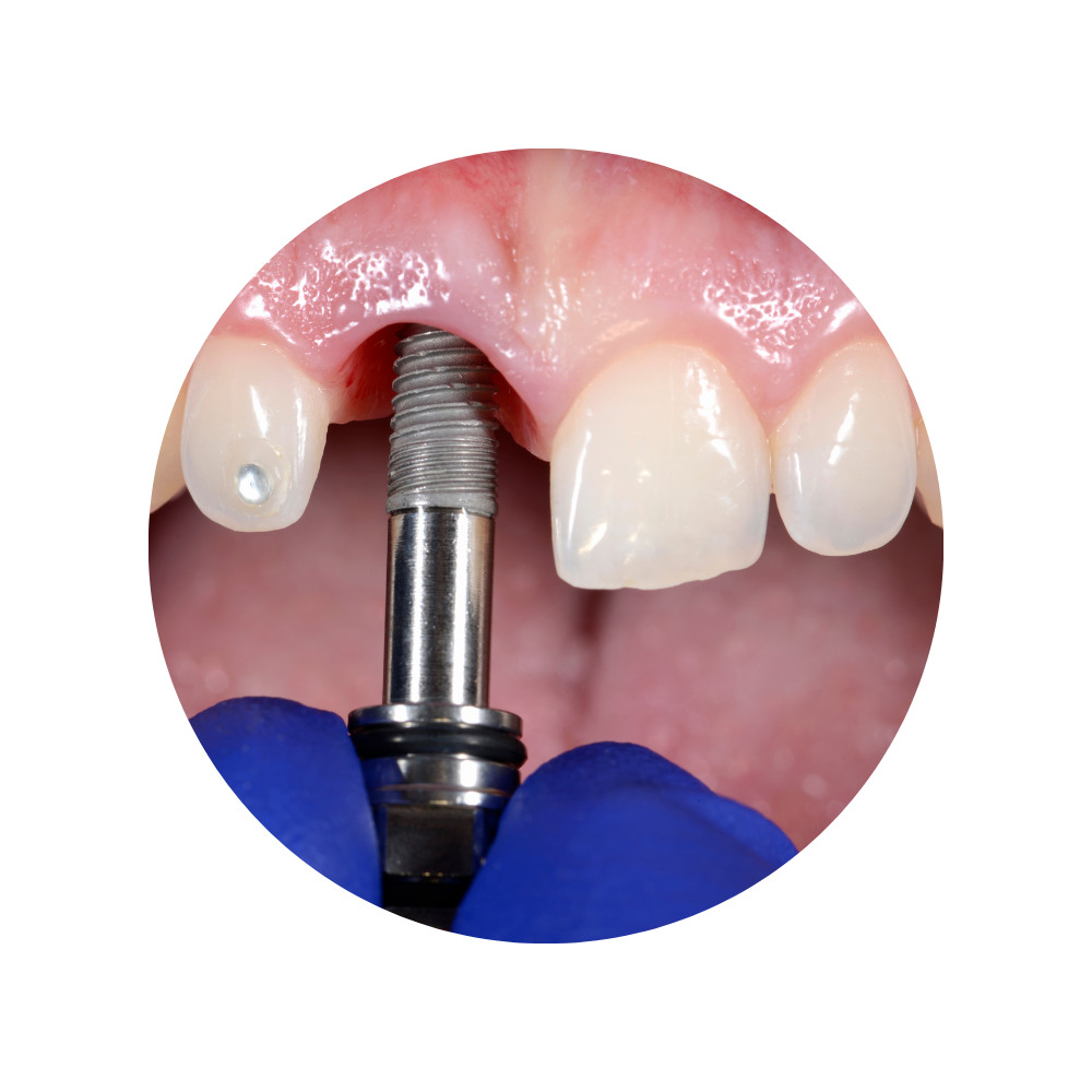 trồng răng implant