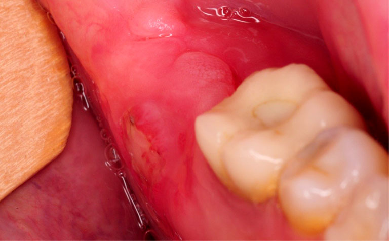 Trồng răng Implant 2