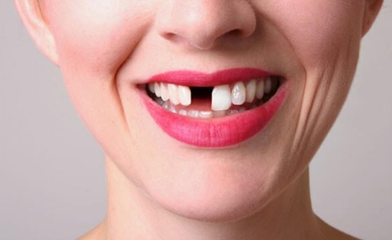 Trồng răng Implant
