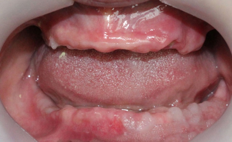 Trồng răng Implant