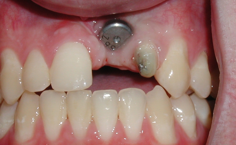 Trồng răng Implant